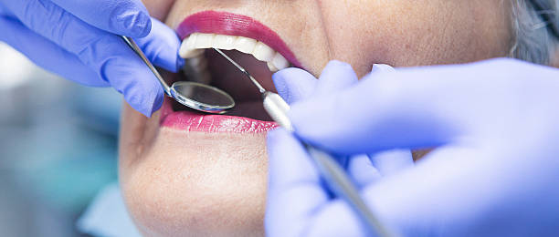 Best Emergency Wisdom Teeth Removal in Byers, CO