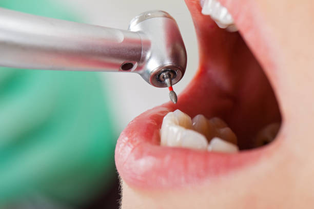 Best Emergency Broken Tooth Repair in Byers, CO